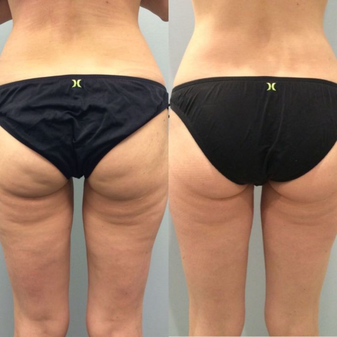 BumBum Cream – Firming & Lifting Body Cream for Cellulite and Stretch Marks